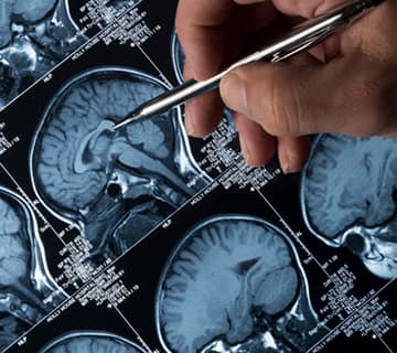 Brain scan images with doctor pointing pen at image